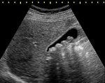 Ultrasound of gallstones